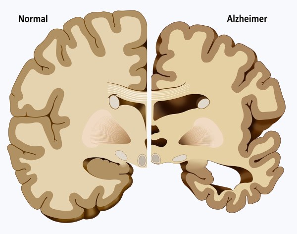 Cerebro Alzheimer